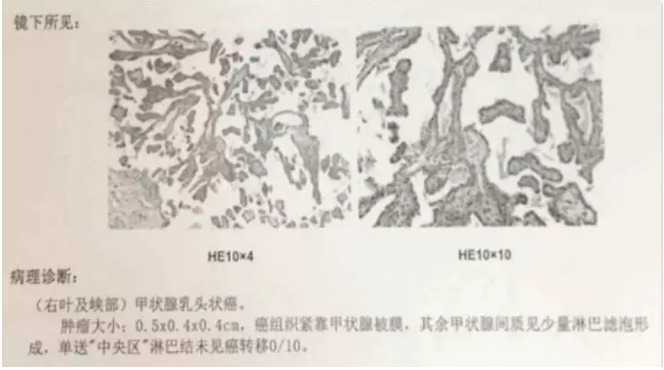 別慌，甲狀腺疾病還可以這樣投保！